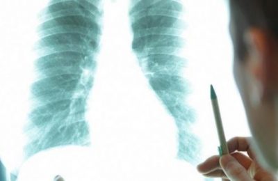 Tầm soát ung thư định kỳ giúp phát hiện bệnh ung thư phổi nguy hiểm.