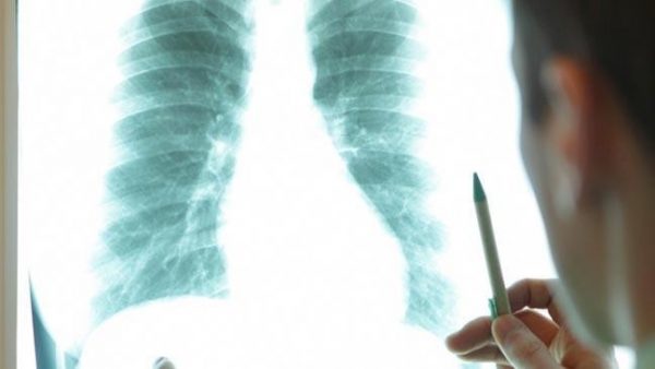 Tầm soát ung thư định kỳ giúp phát hiện bệnh ung thư phổi nguy hiểm.