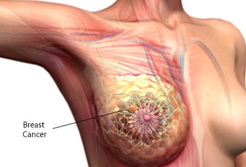 Phát hiện ung thư vú qua dấu hiệu ở núm vú.